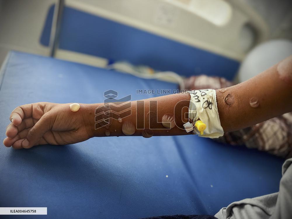 Gaza Children Skin Diseases - Khan Yunis