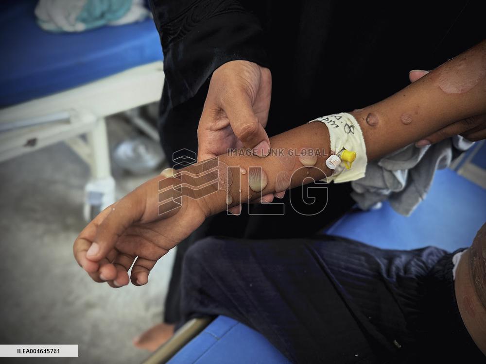 Gaza Children Skin Diseases - Khan Yunis