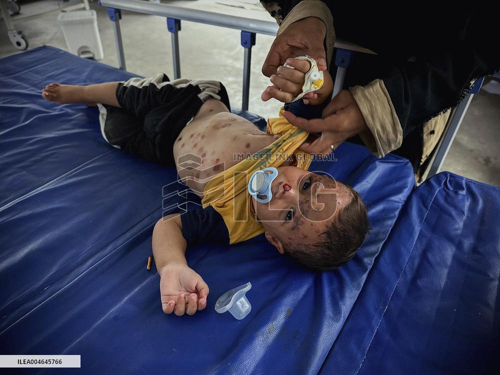 Gaza Children Skin Diseases - Khan Yunis