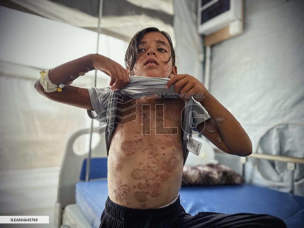 Gaza Children Skin Diseases - Khan Yunis