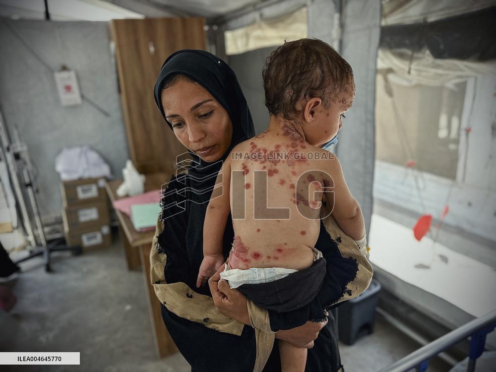 Gaza Children Skin Diseases - Khan Yunis