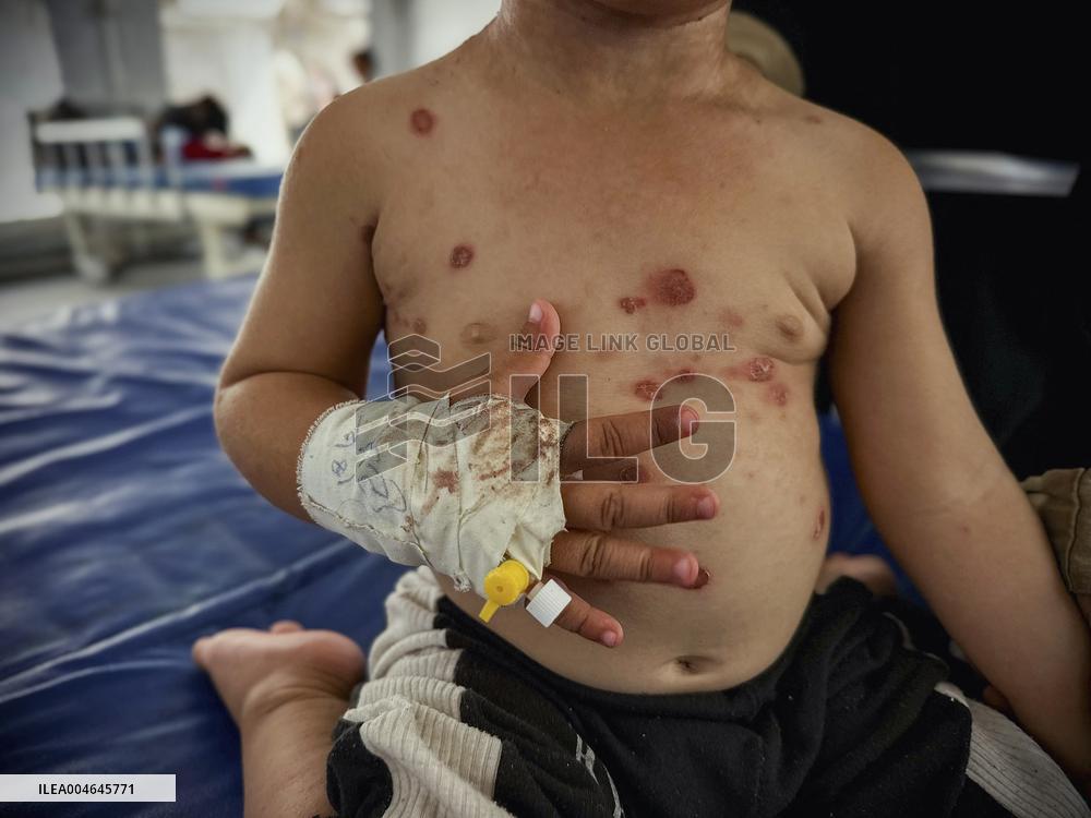 Gaza Children Skin Diseases - Khan Yunis