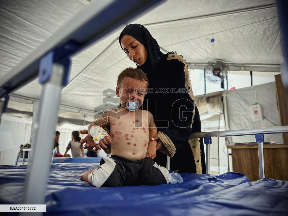 Gaza Children Skin Diseases - Khan Yunis