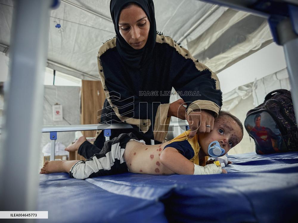 Gaza Children Skin Diseases - Khan Yunis