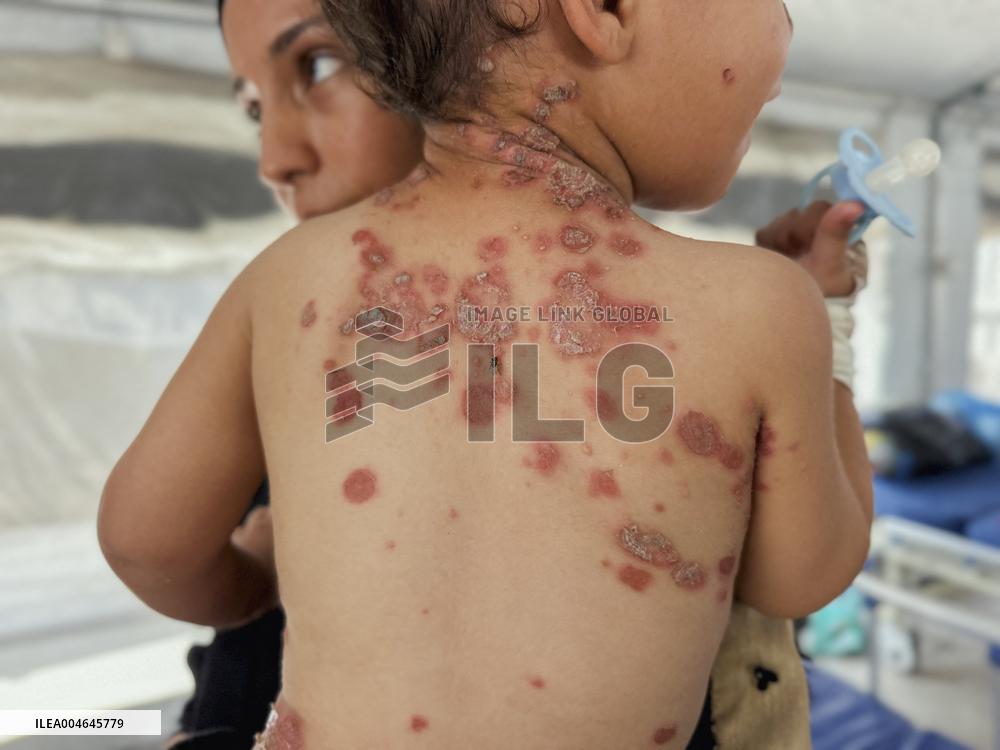 Gaza Children Skin Diseases - Khan Yunis