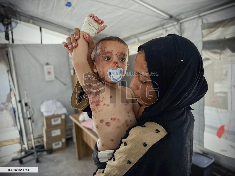 Gaza Children Skin Diseases - Khan Yunis