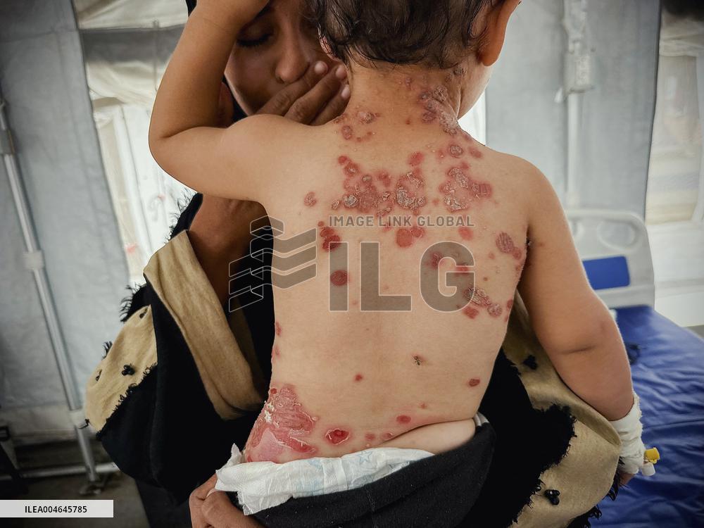 Gaza Children Skin Diseases - Khan Yunis