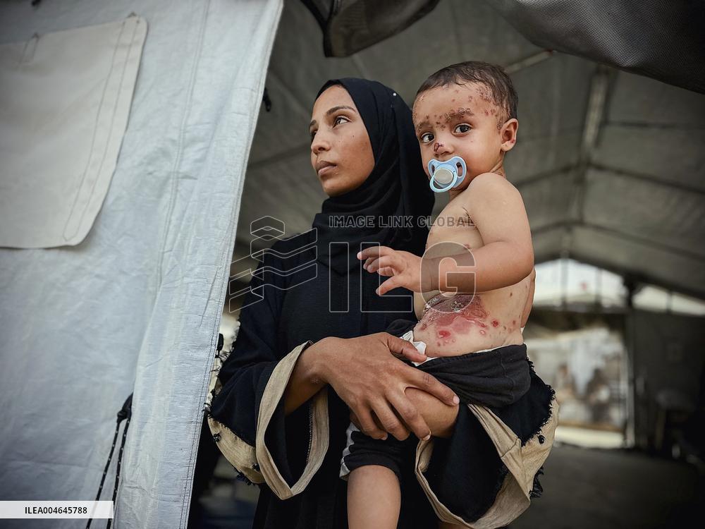 Gaza Children Skin Diseases - Khan Yunis