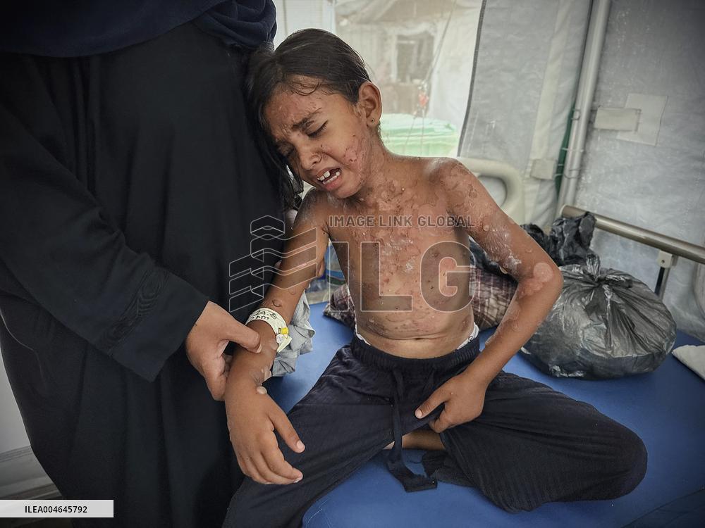 Gaza Children Skin Diseases - Khan Yunis