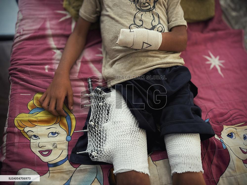 Child Loses Arm in Israel Gaza Conflict