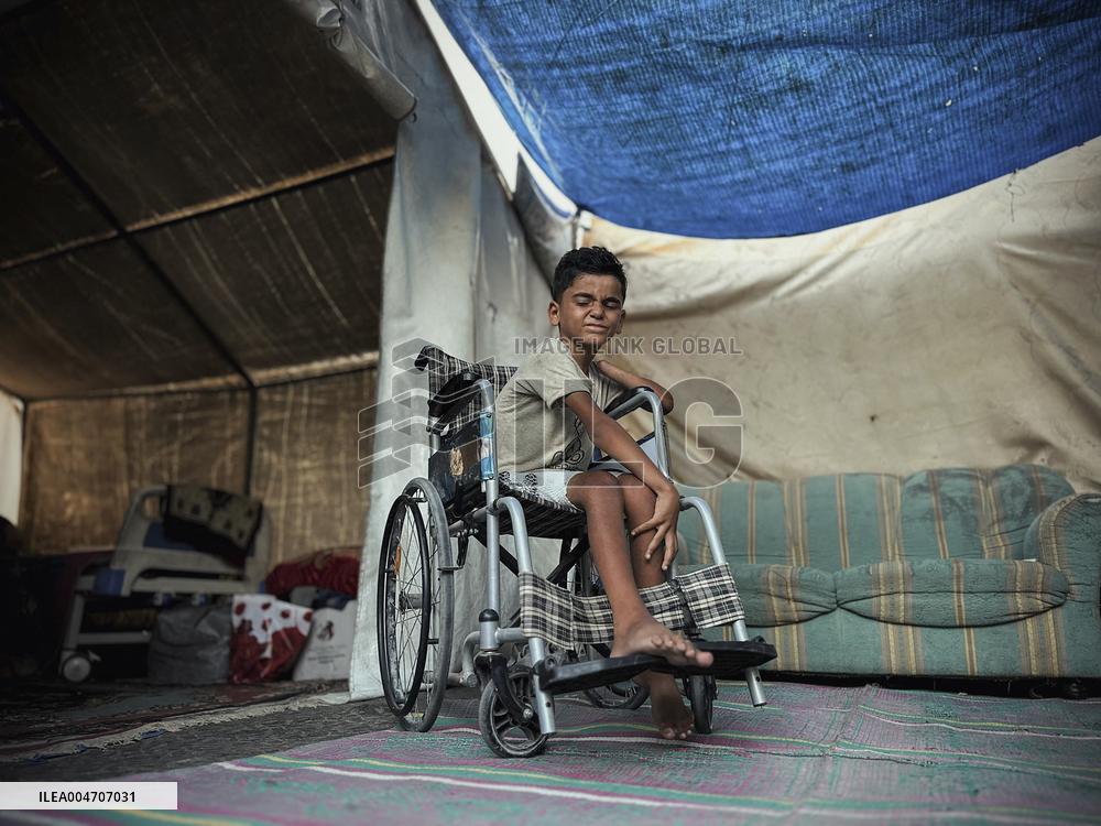 Child Loses Arm in Israel Gaza Conflict