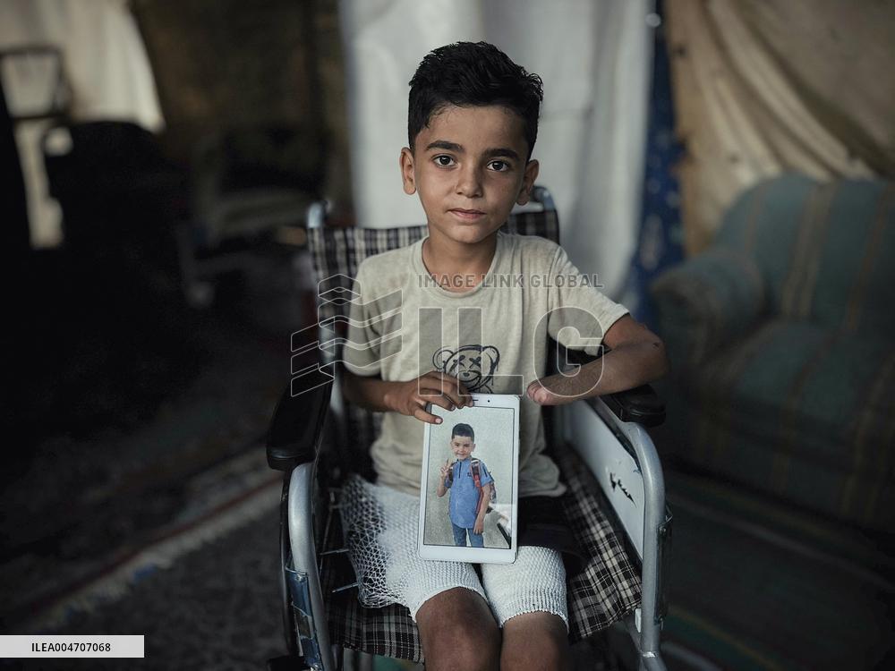 Child Loses Arm in Israel Gaza Conflict