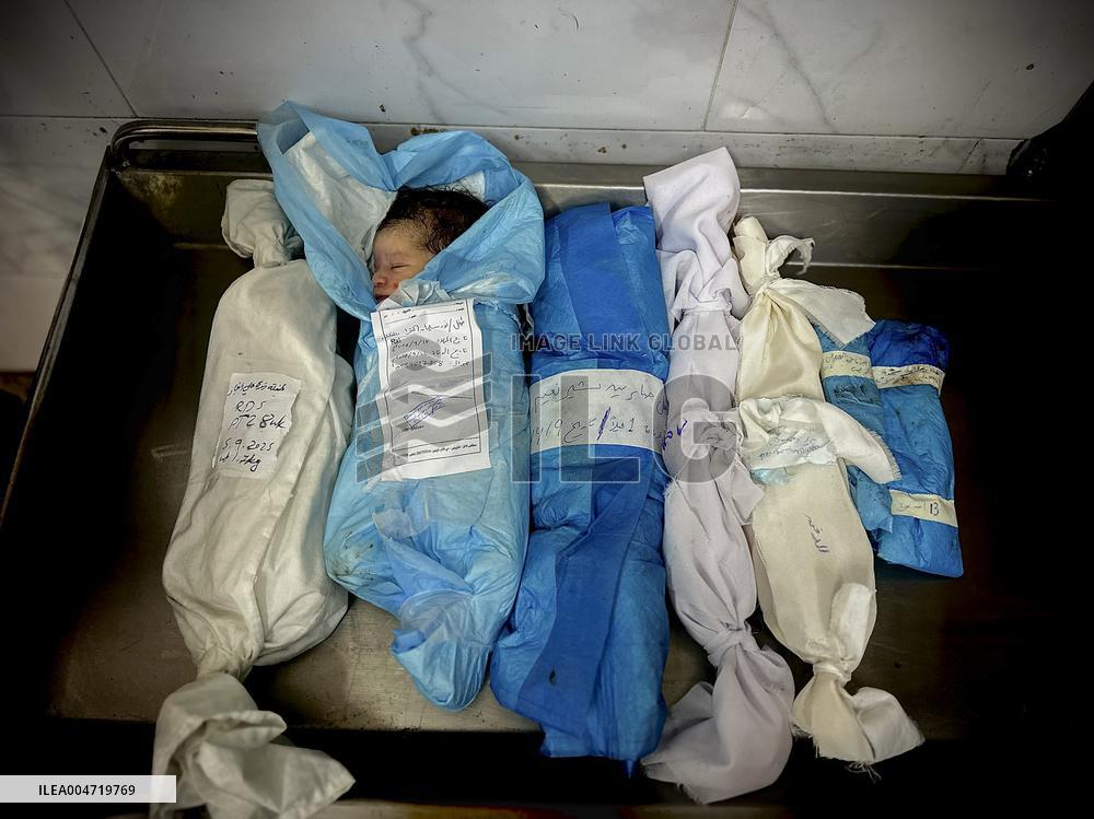 Children Die Amid Malnutrition in Khan Yunis - Palestine