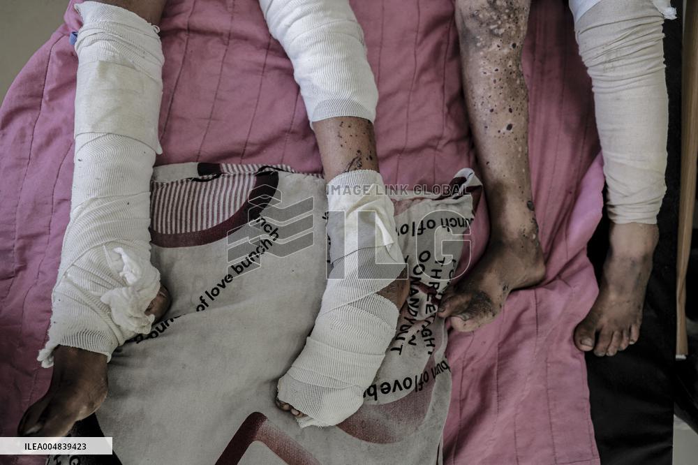 Injured Gaza Children - Palestine