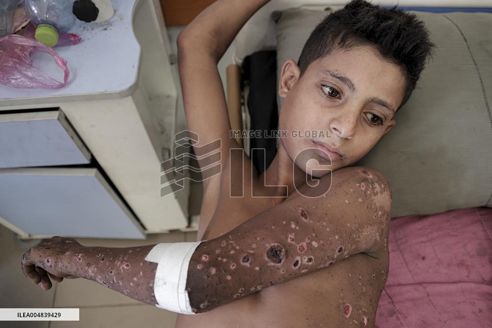 Injured Gaza Children - Palestine