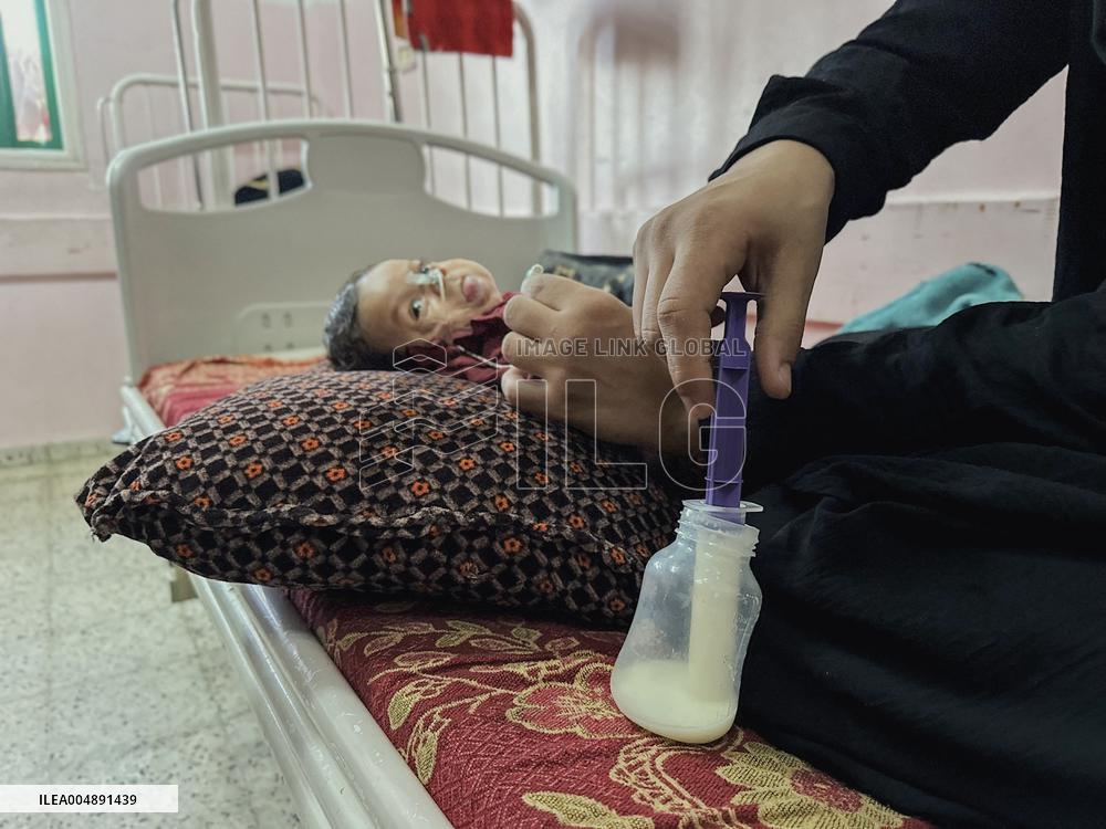 Gaza Baby With Beckwith-Wiedemann Syndrome - Palestine