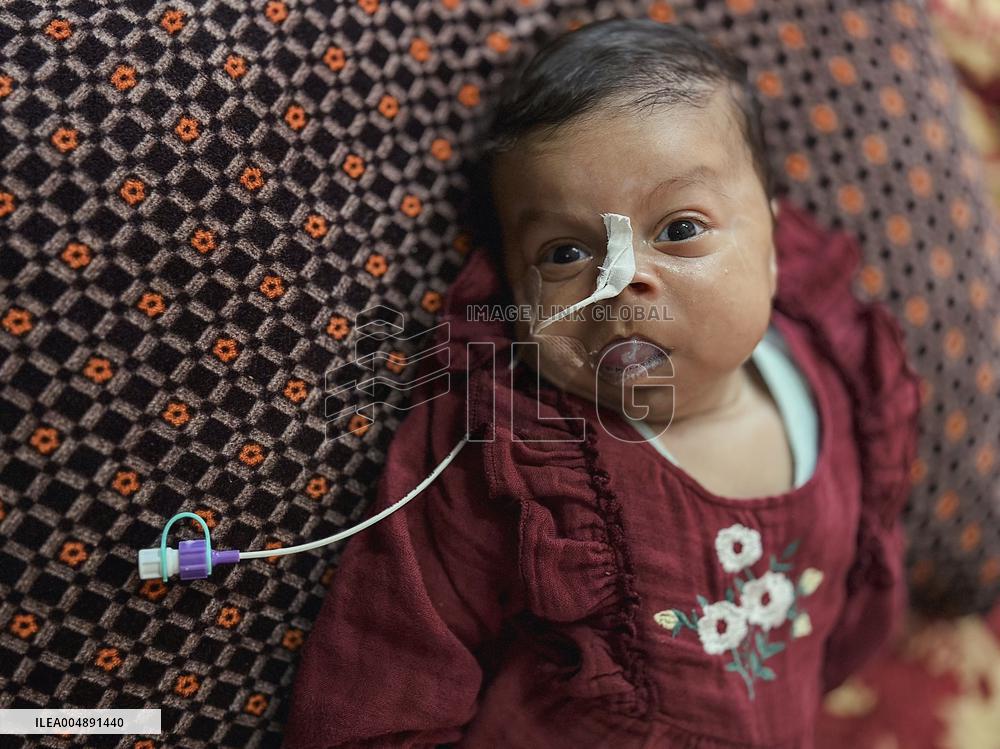 Gaza Baby With Beckwith-Wiedemann Syndrome - Palestine