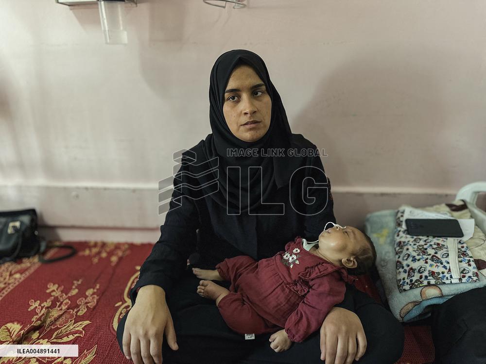 Gaza Baby With Beckwith-Wiedemann Syndrome - Palestine