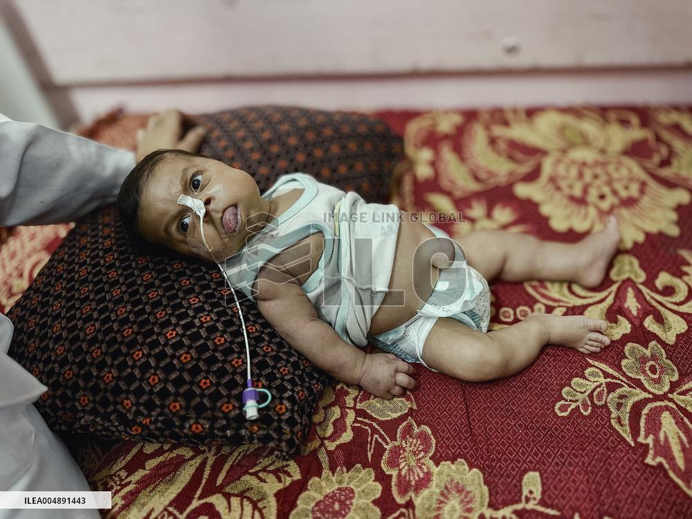 Gaza Baby With Beckwith-Wiedemann Syndrome - Palestine
