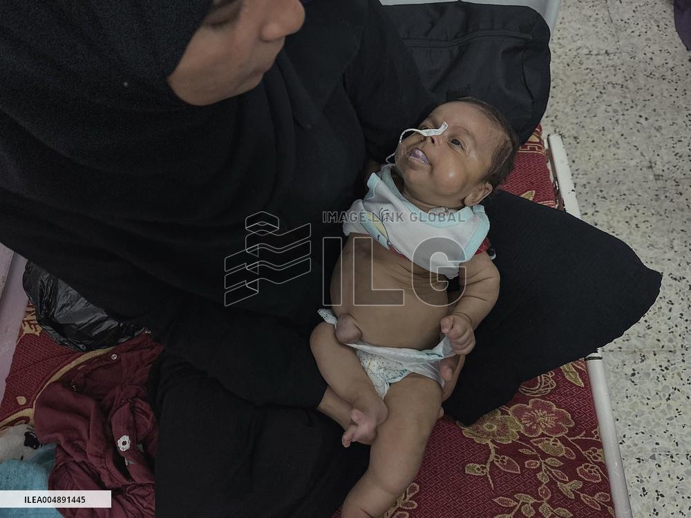 Gaza Baby With Beckwith-Wiedemann Syndrome - Palestine